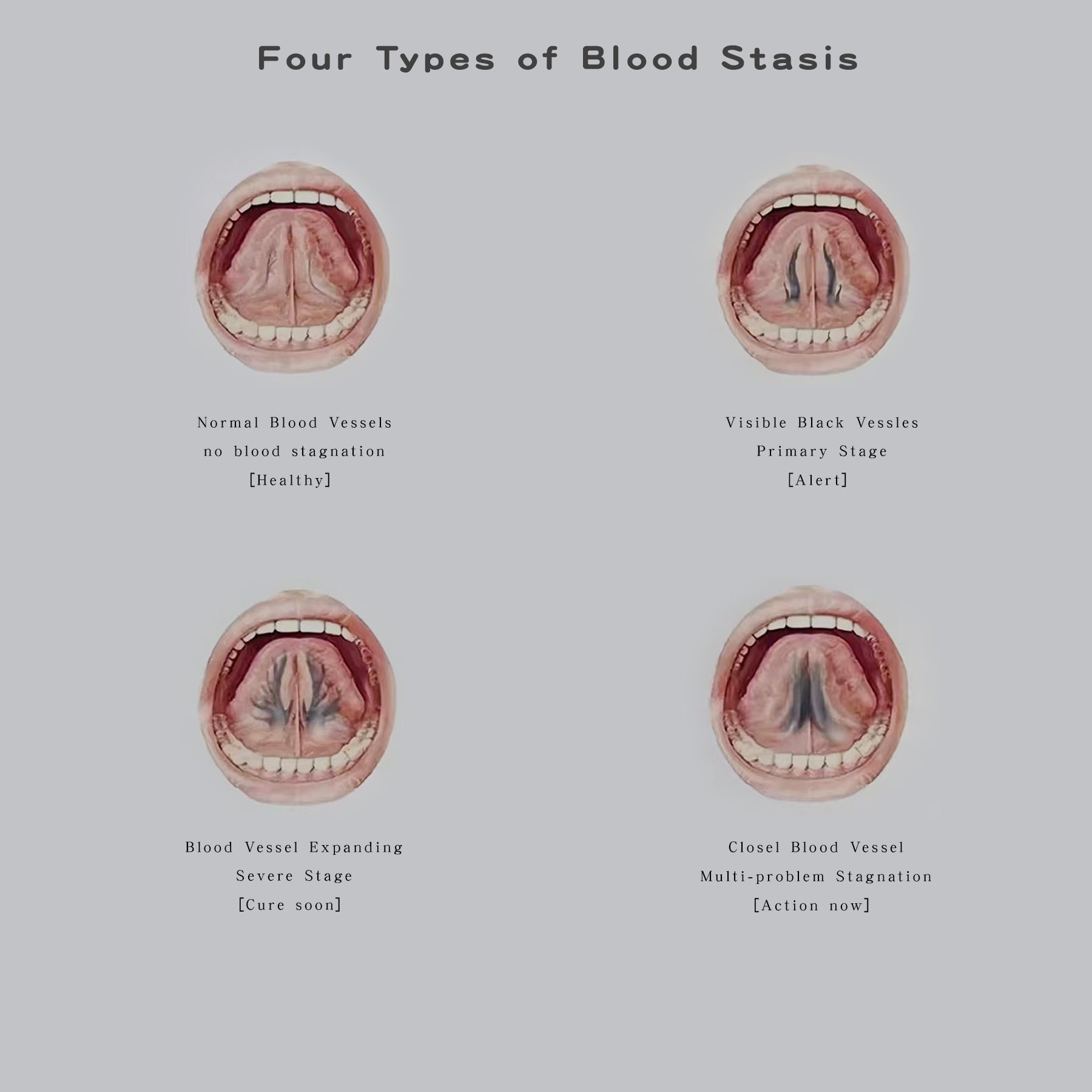 Diseases and symptoms caused by Qi stagnation and blood stasis